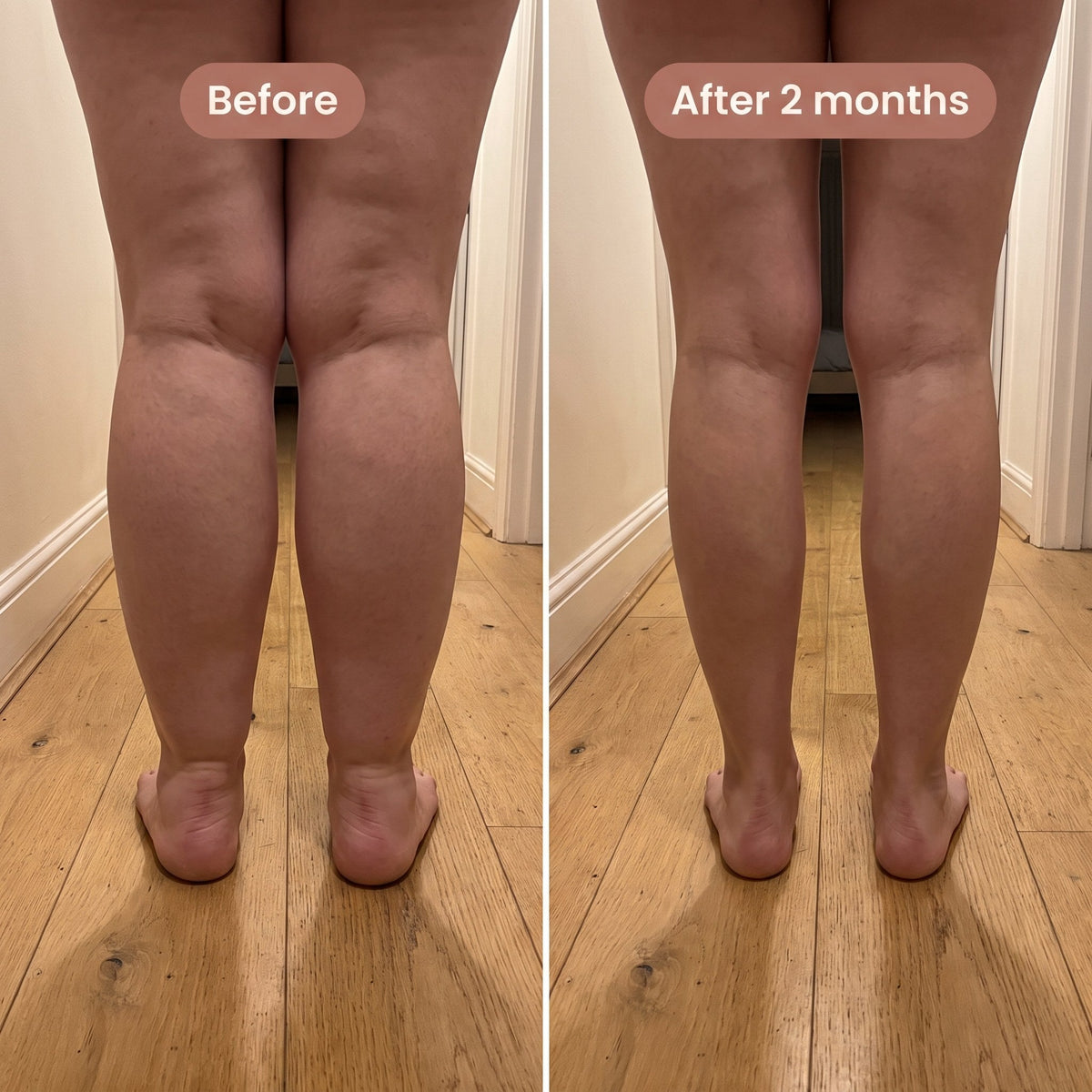 Maneele 4D Lipedema Leggings
